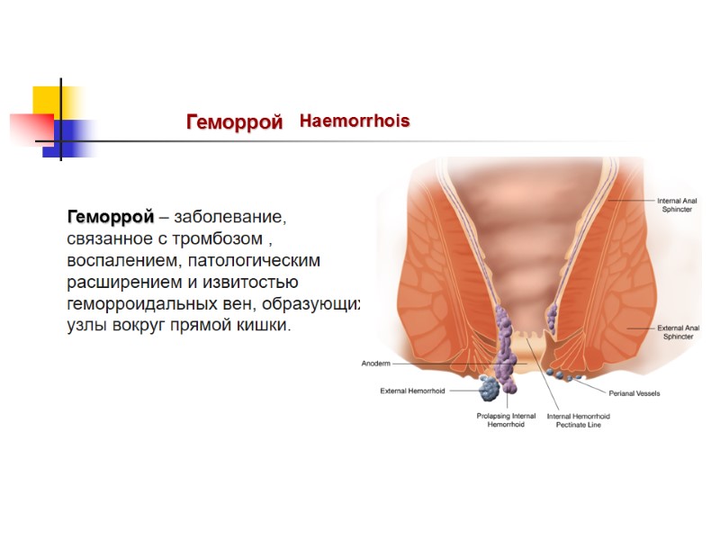 Геморрой Haemorrhois Геморрой – заболевание, связанное с тромбозом , воспалением, патологическим расширением и извитостью